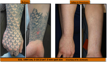 Laser Tattoo Removal Training - IAPAM Aesthetic Medicine ...