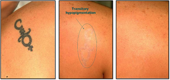 IAPAM_Tattoo_Removal